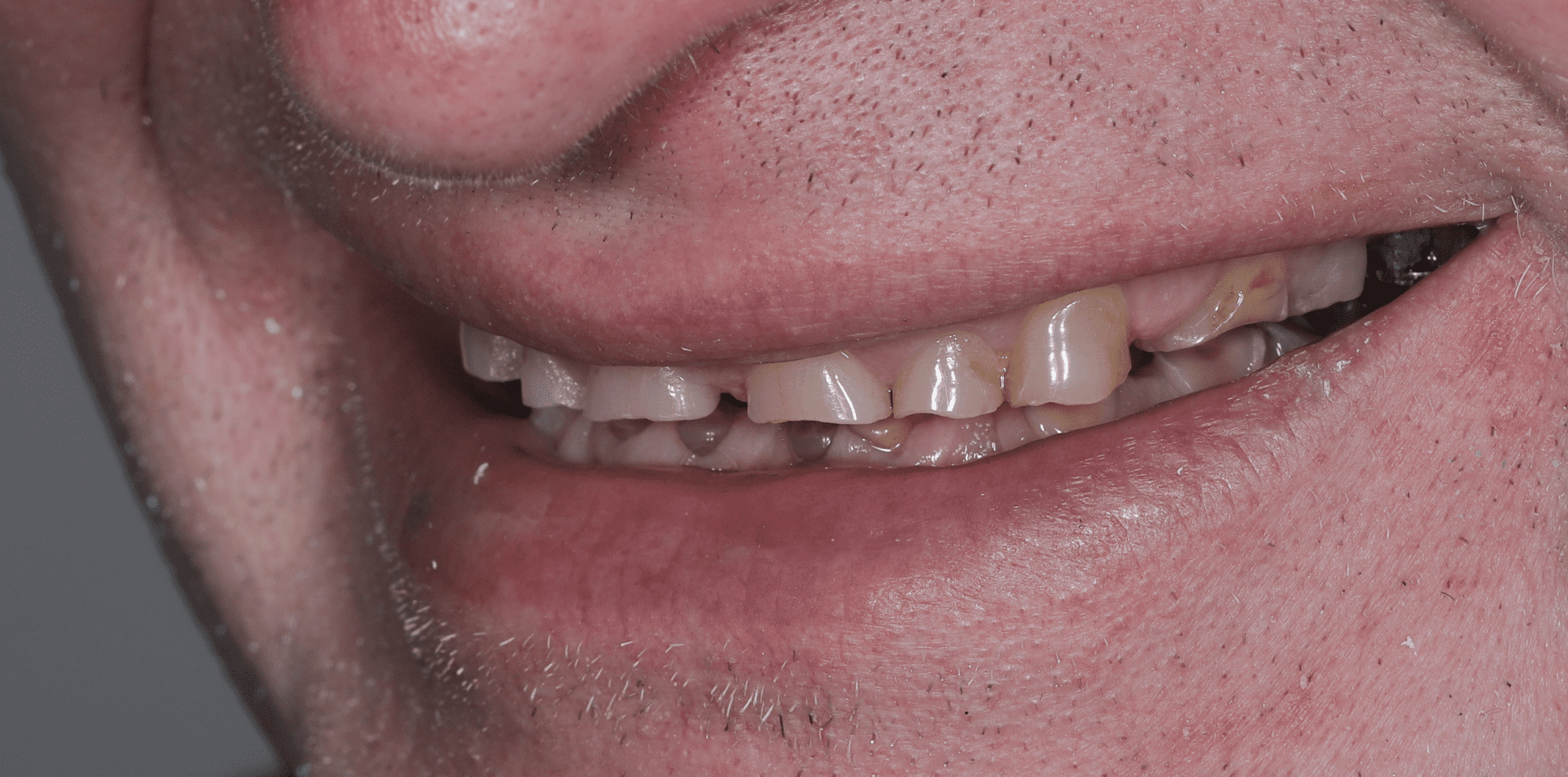 desgaste dentário-reabilitação complexa-antes