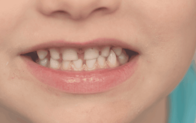 Dents de lait : faut-il les soigner puisqu’elles vont tomber ? Mythe à déconstruire