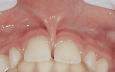 Pourquoi choisir le laser pour la frénectomie chez les enfants ?