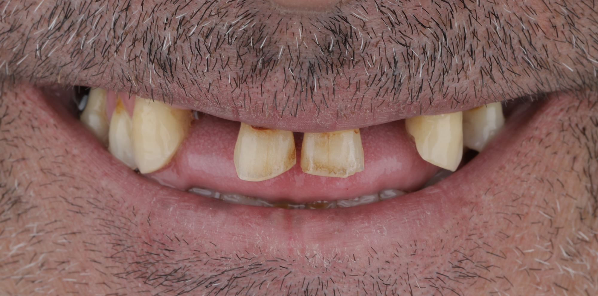 Réhabilitation implantaire complète par technique All-On-6 antes