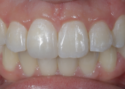 Correction de l&rsquo;encombrement dentaire par orthodontie