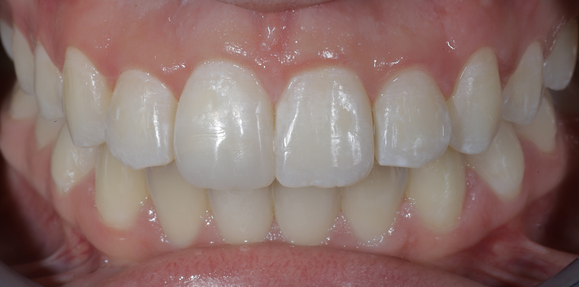 Correção do apinhamento dentário com tratamento ortodôntico depois