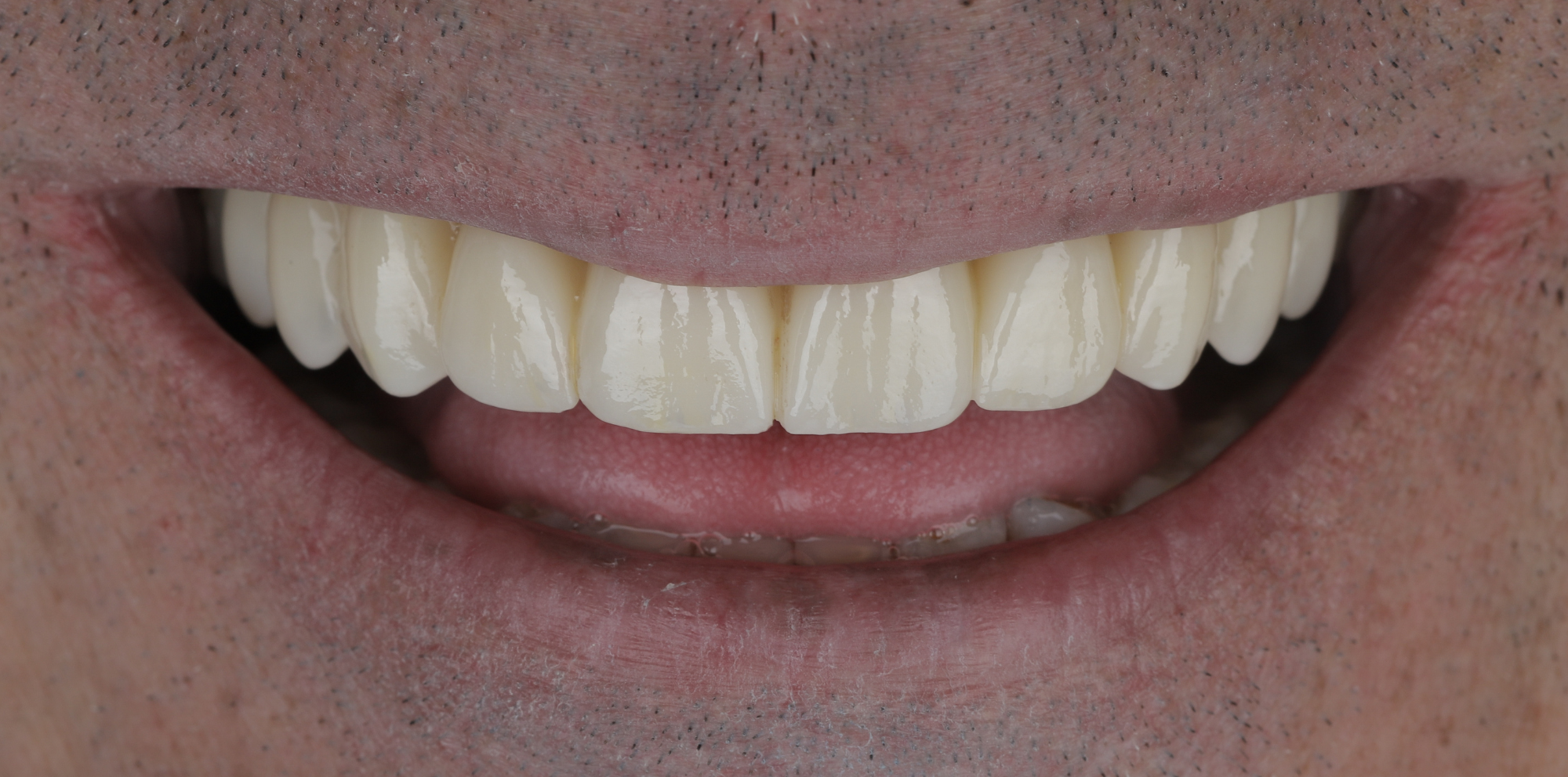 Réhabilitation implantaire complète par technique All-On-6 depois