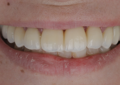 Réhabilitation orale complète – transformation du sourire