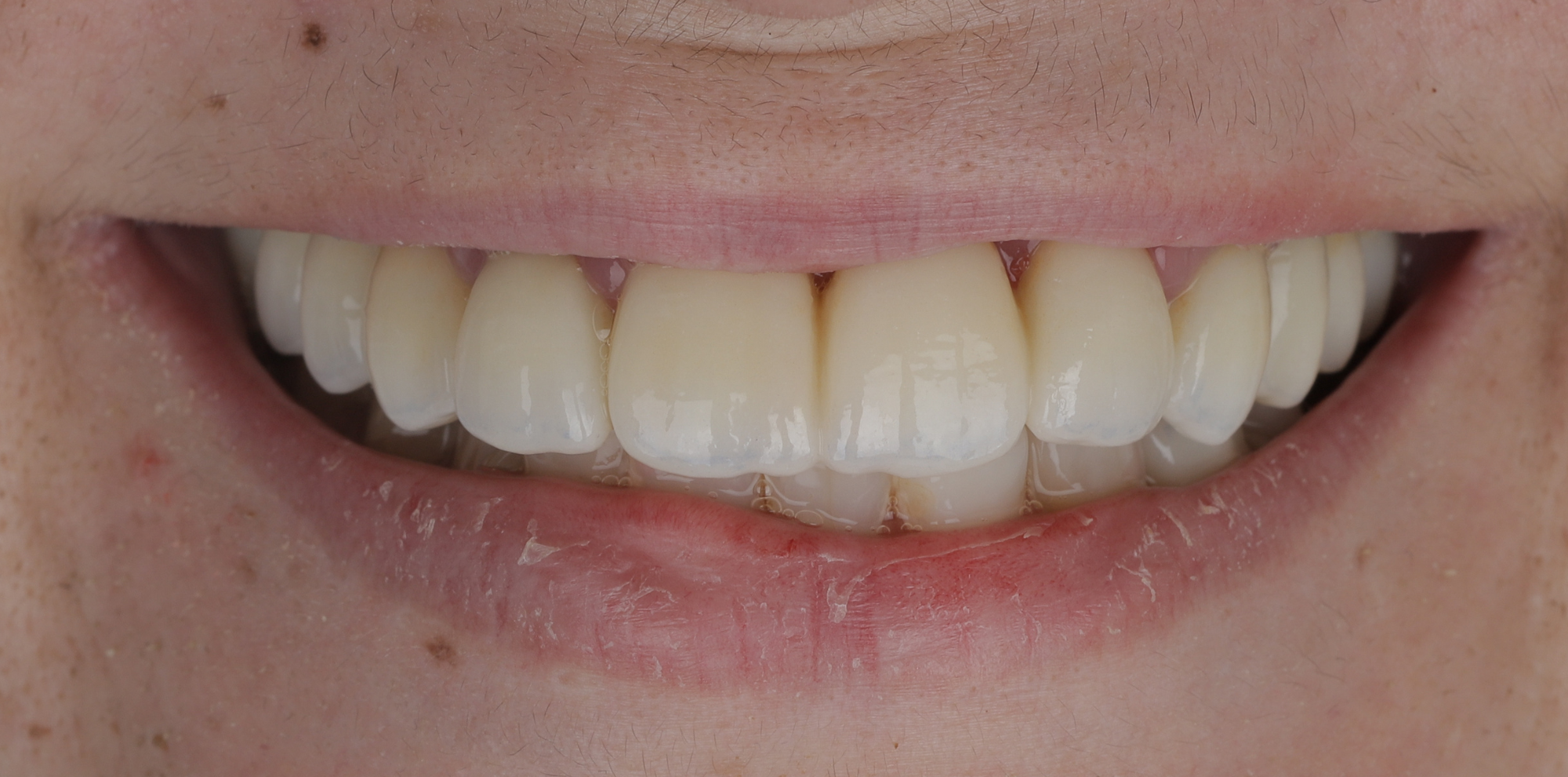 Reabilitação oral completa - transformação do sorriso francês