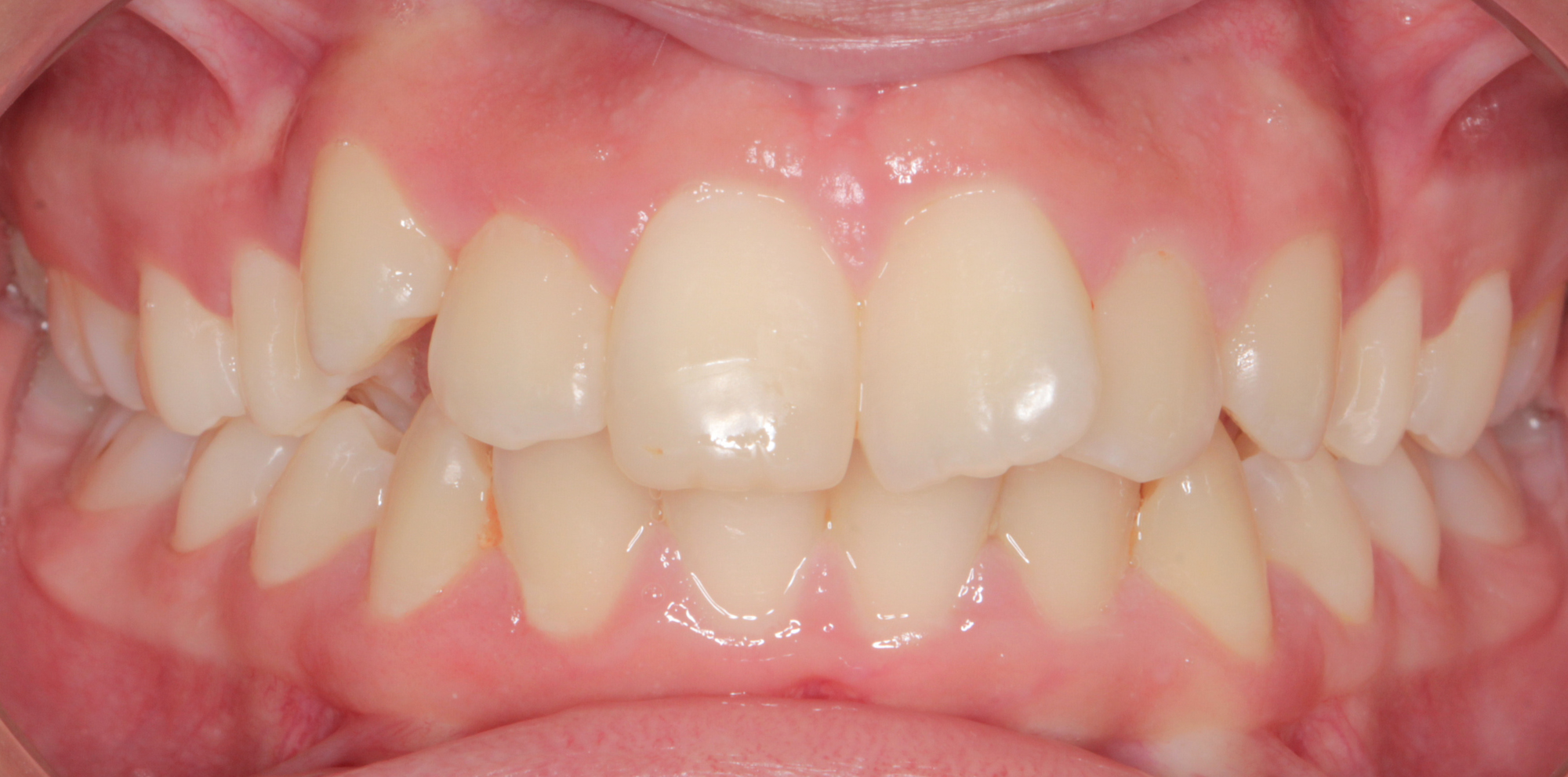 Correção do apinhamento dentário com tratamento ortodôntico