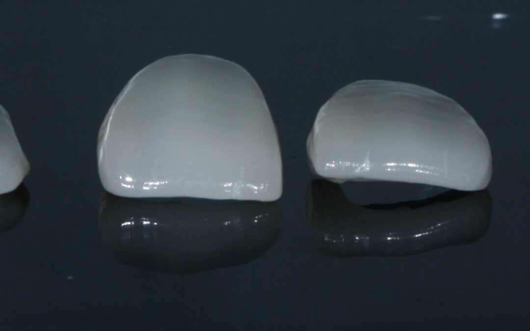 Facetas dentárias: para quem são indicadas e qual é o preço?