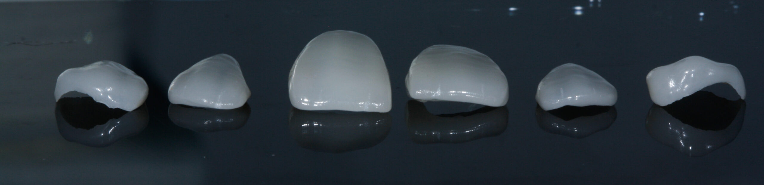 ngo-illustration-Artboard 5 Facettes dentaires : pour qui et à quel prix ?