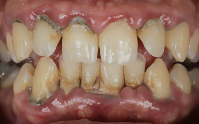 Gencives qui saignent : est-ce grave ?