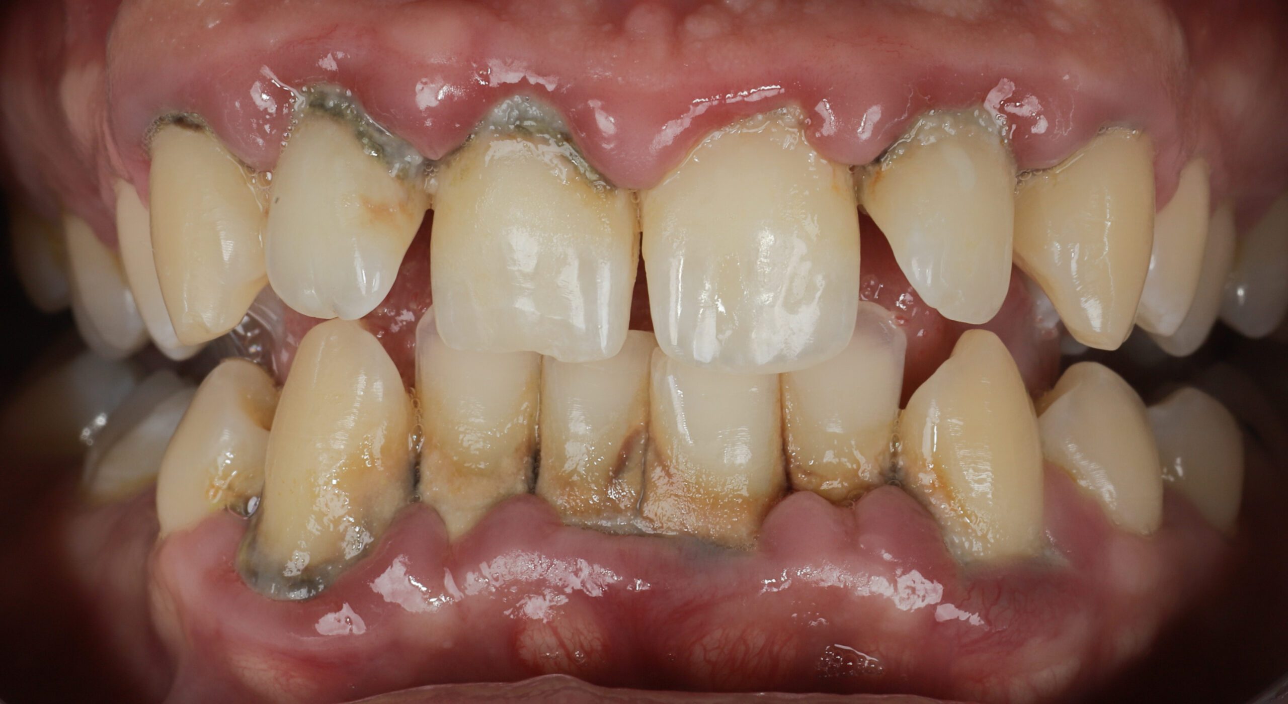 Gencives qui saignent : est-ce grave ?