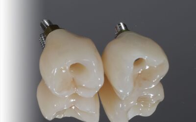 Combien coûte un implant dentaire en Suisse ?